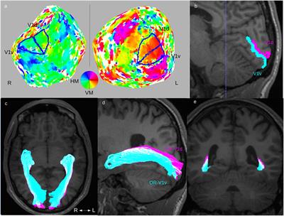 Injuries to the Immature Optic Radiation Show Correlated Thinning of the Macular Ganglion Cell Layer